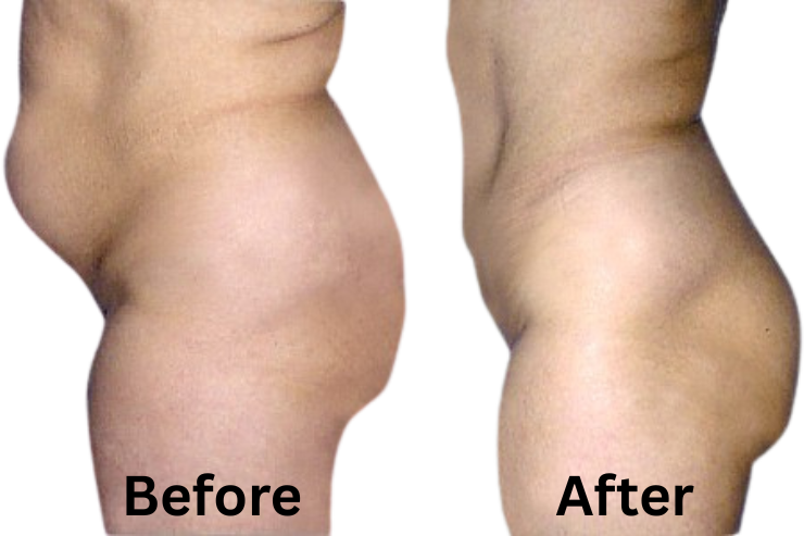 Tummy Tuck