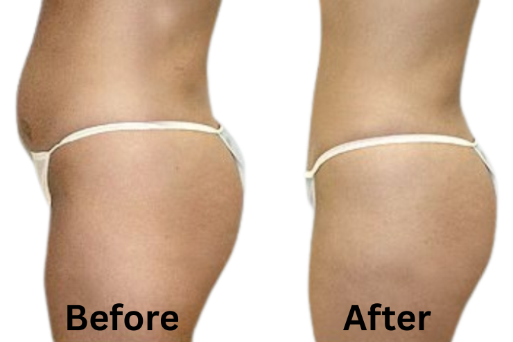Tummy Tuck