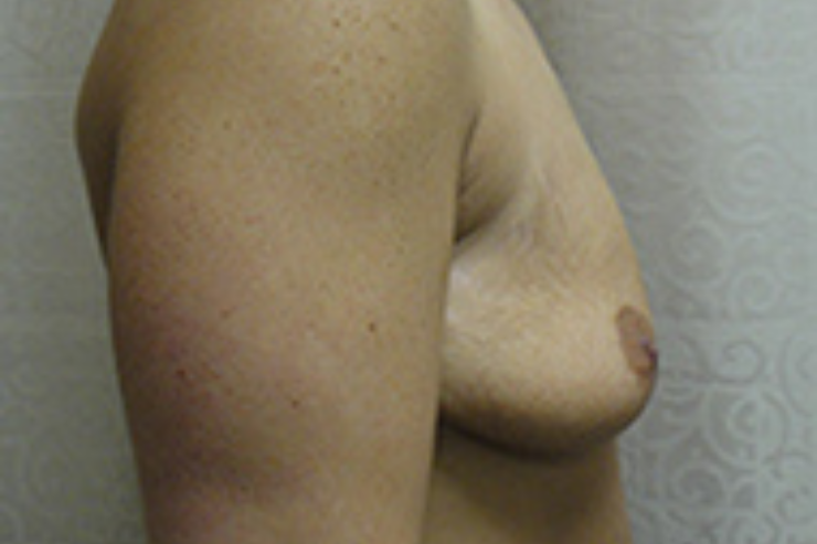 Breast Augmentation