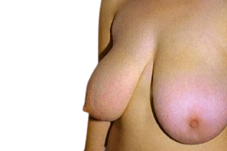 Breast Reduction