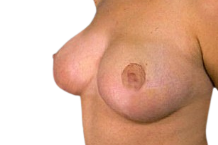 Breast Reduction