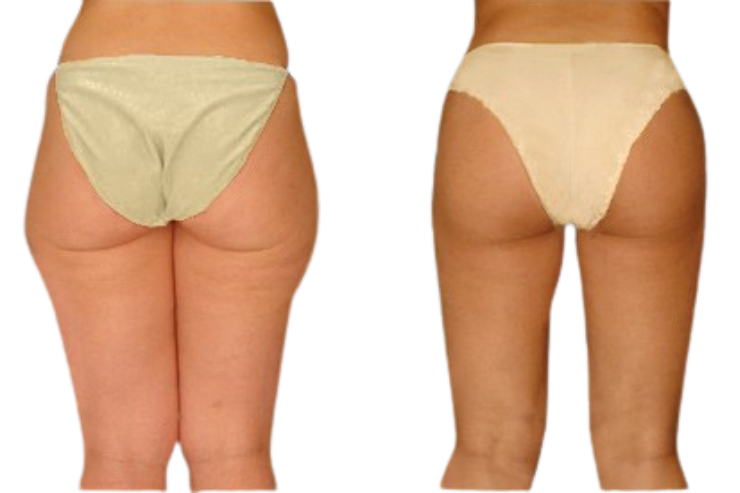 Liposuction