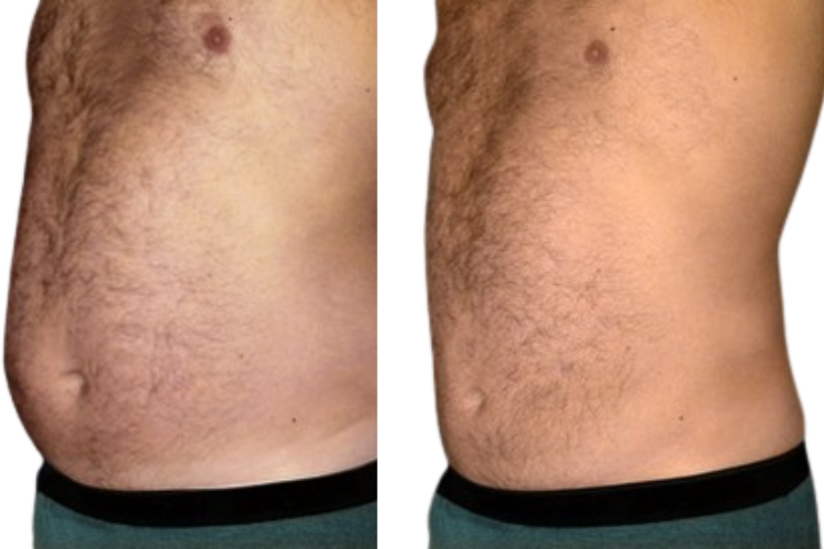 Liposuction